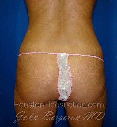 Liposuction Before & After Patient #1669