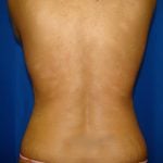 Liposuction Before & After Patient #1669