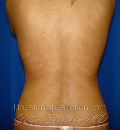 Liposuction Before & After Patient #1669