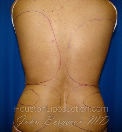 Liposuction Before & After Patient #1669