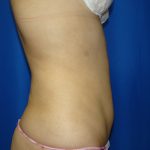 Liposuction Before & After Patient #1759