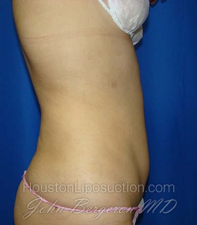 Liposuction Before & After Patient #1759