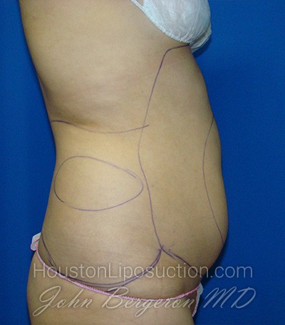 Liposuction Before & After Patient #1759