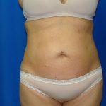 Liposuction Before & After Patient #1685