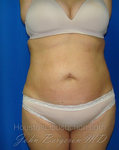 Liposuction Before & After Patient #1685