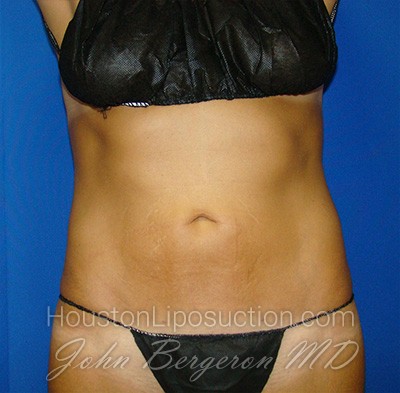Liposuction Before & After Patient #1690