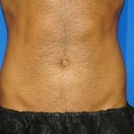 Liposuction Before & After Patient #1700