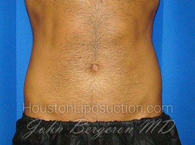 Liposuction Before & After Patient #1700