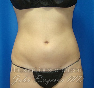 Liposuction Before & After Patient #1714