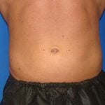 Liposuction Before & After Patient #1738