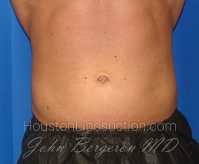 Liposuction Before & After Patient #1738