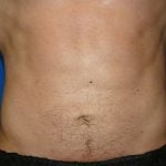 Liposuction Before & After Patient #1745