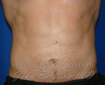 Liposuction Before & After Patient #1745