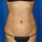 Liposuction Before & After Patient #1752