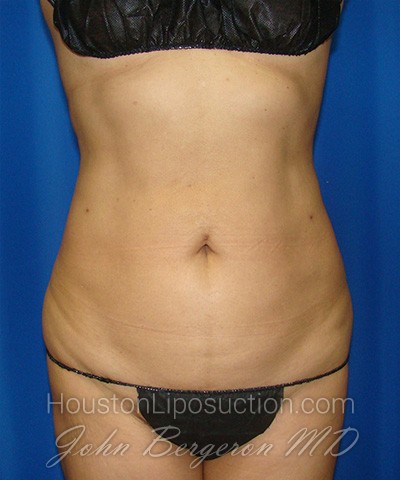 Liposuction Before & After Patient #1752