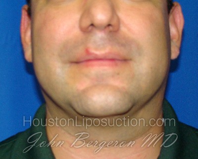 Liposuction Before & After Patient #1664