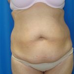Liposuction Before & After Patient #1685
