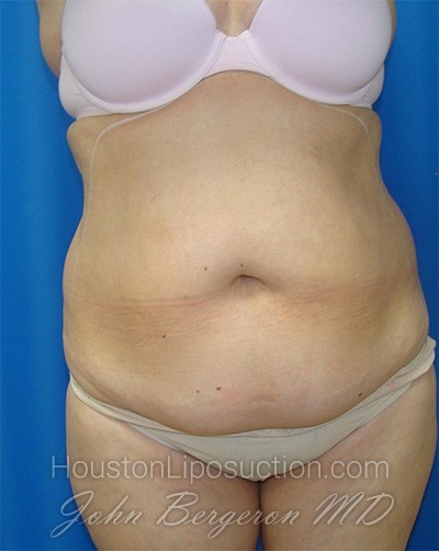 Liposuction Before & After Patient #1685