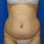 Liposuction Before & After Patient #1759