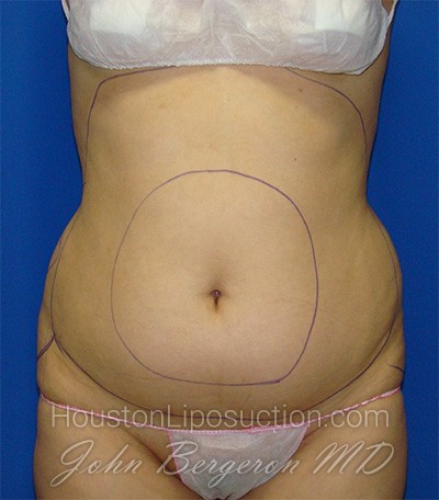 Liposuction Before & After Patient #1759