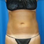 Liposuction Before & After Patient #1690