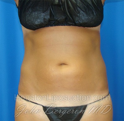 Liposuction Before & After Patient #1690