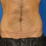 Liposuction Before & After Patient #1700