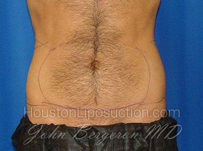 Liposuction Before & After Patient #1700