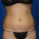 Liposuction Before & After Patient #1714