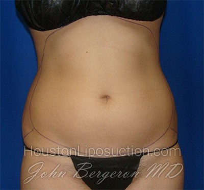 Liposuction Before & After Patient #1714