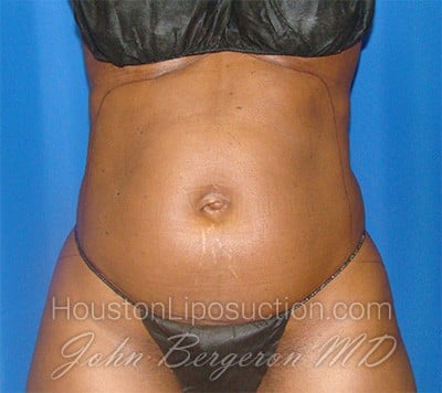 Liposuction Before & After Patient #1723