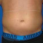 Liposuction Before & After Patient #1738
