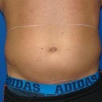 Liposuction Before & After Patient #1738