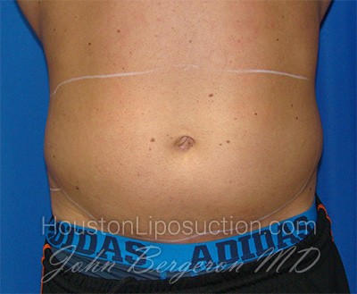 Liposuction Before & After Patient #1738