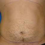 Liposuction Before & After Patient #1745