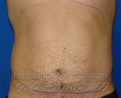 Liposuction Before & After Patient #1745