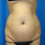 Liposuction Before & After Patient #1752