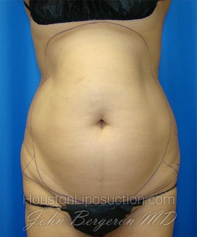 Liposuction Before & After Patient #1752