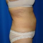 Liposuction Before & After Patient #1685