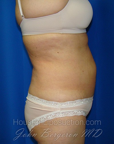 Liposuction Before & After Patient #1685