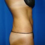 Liposuction Before & After Patient #1690