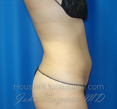 Liposuction Before & After Patient #1714