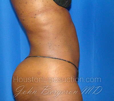 Liposuction Before & After Patient #1723