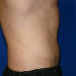 Liposuction Before & After Patient #1745