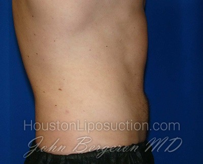 Liposuction Before & After Patient #1745