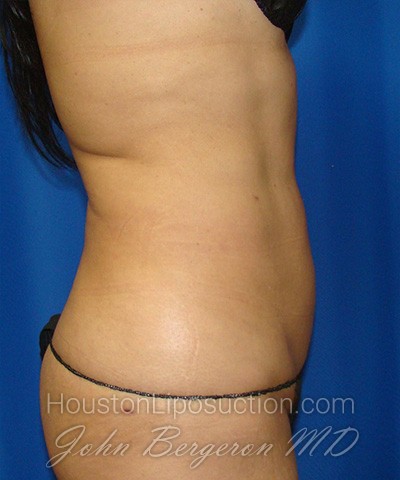 Liposuction Before & After Patient #1752