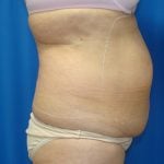 Liposuction Before & After Patient #1685