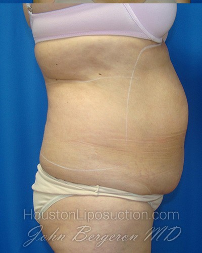 Liposuction Before & After Patient #1685