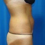 Liposuction Before & After Patient #1690