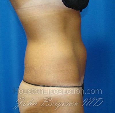 Liposuction Before & After Patient #1690